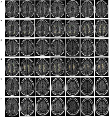 Automatic segmentation of white matter hyperintensities and correlation analysis for cerebral small vessel disease
